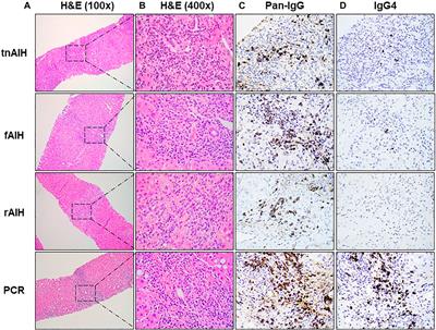 Differential IgG4-Producing Plasma Cell Infiltration in Non- and Post-Transplant Plasma Cell Hepatitis